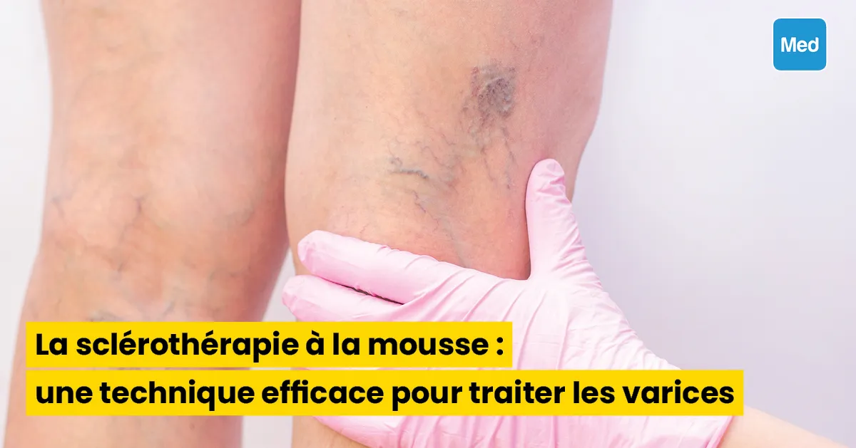 La sclérothérapie à la mousse : une technique efficace pour traiter les varices